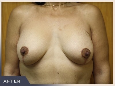 Massive Weight Loss Before & After Patient #780