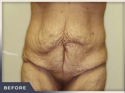 Massive Weight Loss Before & After Patient #780