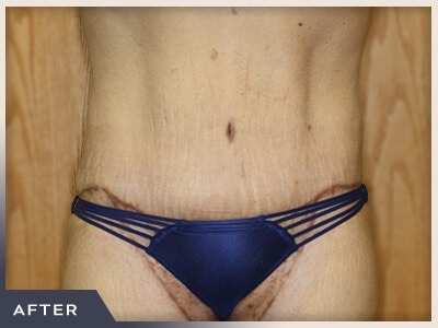 Massive Weight Loss Before & After Patient #780