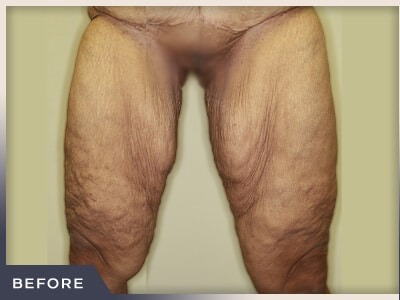 Massive Weight Loss Before & After Patient #780