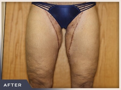 Massive Weight Loss Before & After Patient #780