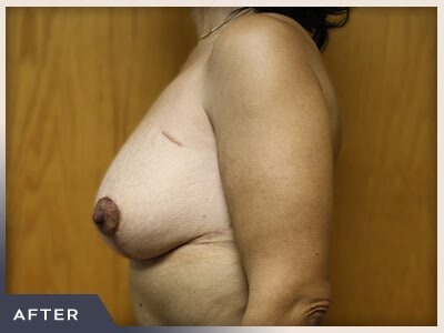Massive Weight Loss Before & After Patient #780