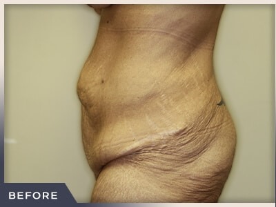 Massive Weight Loss Before & After Patient #780