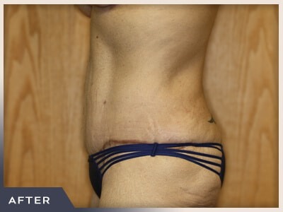 Massive Weight Loss Before & After Patient #780