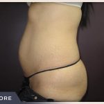 Abdominoplasty Before & After Patient #783