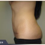 Abdominoplasty Before & After Patient #783