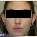 Otoplasty Before & After Patient #807
