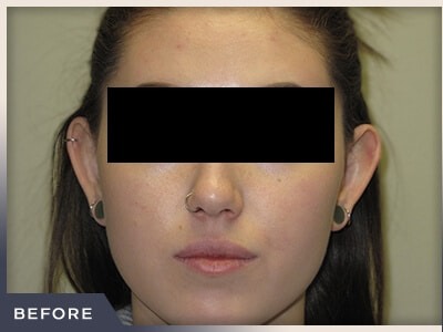 Otoplasty Before & After Patient #807