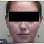 Otoplasty Before & After Patient #807