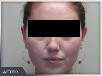 Otoplasty Before & After Patient #807