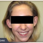 Otoplasty Before & After Patient #806