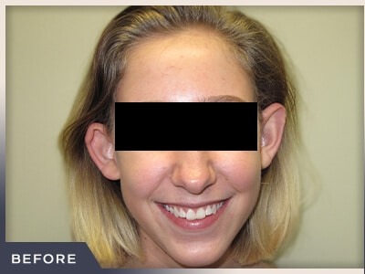 Otoplasty Before & After Patient #806