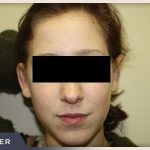 Otoplasty Before & After Patient #806