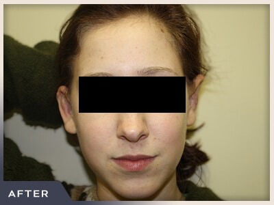 Otoplasty Before & After Patient #806