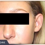 Otoplasty Before & After Patient #806