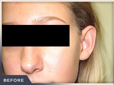 Otoplasty Before & After Patient #806