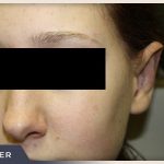 Otoplasty Before & After Patient #806