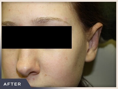 Otoplasty Before & After Patient #806
