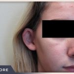 Otoplasty Before & After Patient #806