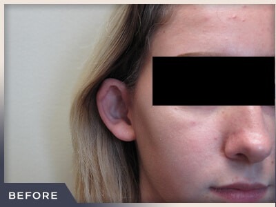 Otoplasty Before & After Patient #806