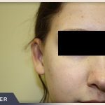 Otoplasty Before & After Patient #806