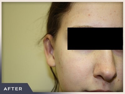 Otoplasty Before & After Patient #806