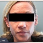 Otoplasty Before & After Patient #805