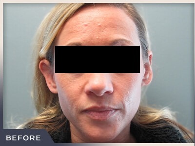 Otoplasty Before & After Patient #805