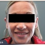 Otoplasty Before & After Patient #805