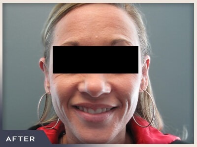 Otoplasty Before & After Patient #805