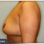 Breast Revision Before & After Patient #491
