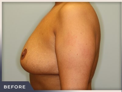 Breast Revision Before & After Patient #491