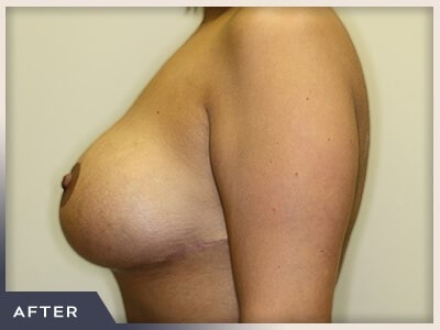 Breast Revision Before & After Patient #491