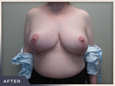 Breast Revision Before & After Patient #492
