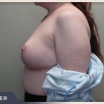Breast Revision Before & After Patient #492