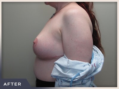 Breast Revision Before & After Patient #492