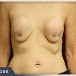Breast Revision Before & After Patient #493