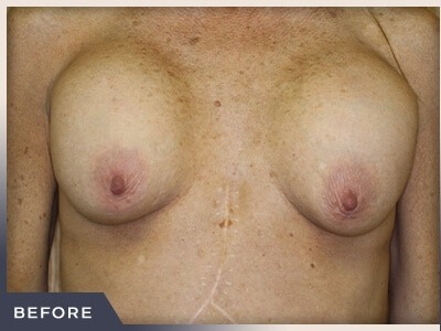 Breast Revision Before & After Patient #494