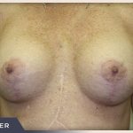 Breast Revision Before & After Patient #494