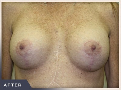 Breast Revision Before & After Patient #494