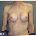 Breast Revision Before & After Patient #495