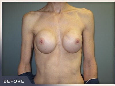 Breast Revision Before & After Patient #495