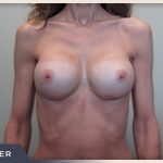 Breast Revision Before & After Patient #495