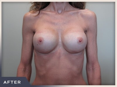 Breast Revision Before & After Patient #495
