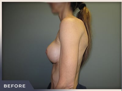 Breast Revision Before & After Patient #495