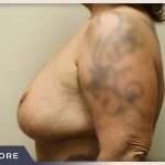 Breast Revision Before & After Patient #496