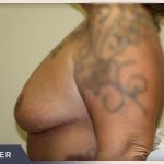 Breast Revision Before & After Patient #496