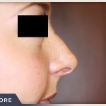 Rhinoplasty Before & After Patient #799