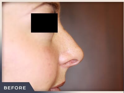 Rhinoplasty Before & After Patient #799
