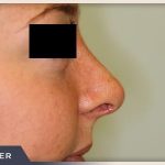 Rhinoplasty Before & After Patient #799